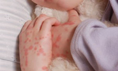 Hand Foot And Mouth Disease While Pregnant Complete Fact Sheet