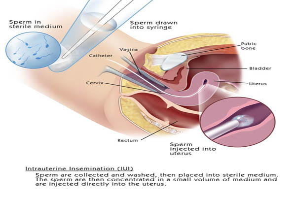 Implantation-After-IUI-INTRAUTERINE-INSEMINATION