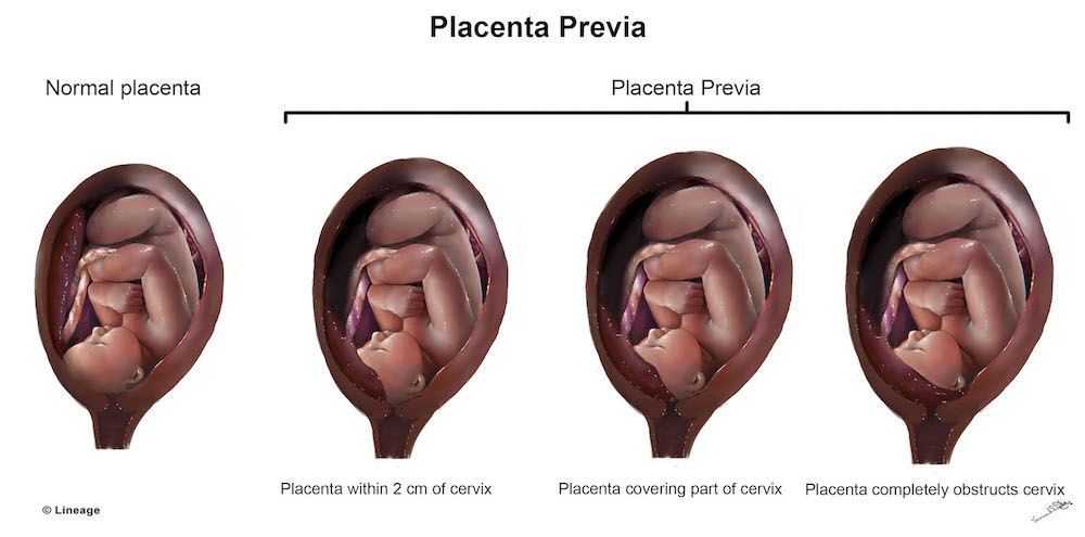 Placenta-Previa-risks