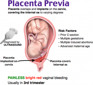 Vasa-Previa-Risks-in-pregnancy