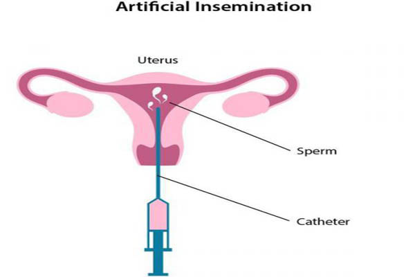 artificial-insemination-Implantation-After-IUI