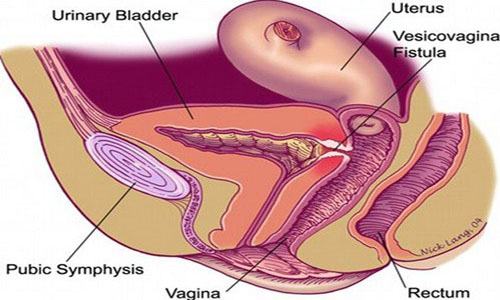 Obstetric-Fistula