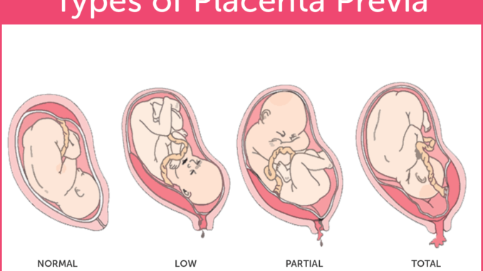 complications-and-risks-of-placenta-previa-during-pregnancy