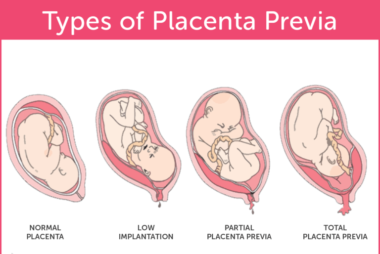 vasa-previa-vs-placenta-previa-symptoms-management-and-treatment