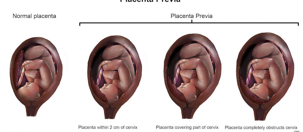 Placenta-Previa-vs-vasa-previa-risks