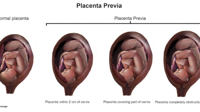 Vasa Previa VS Placenta Previa Symptoms, Management And Treatment