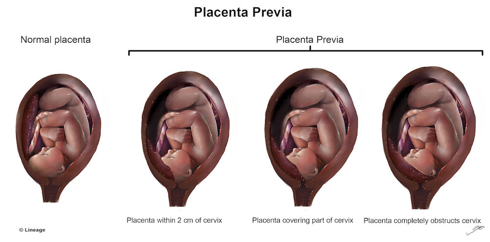 Vasa Previa VS Placenta Previa Symptoms, Management And Treatment