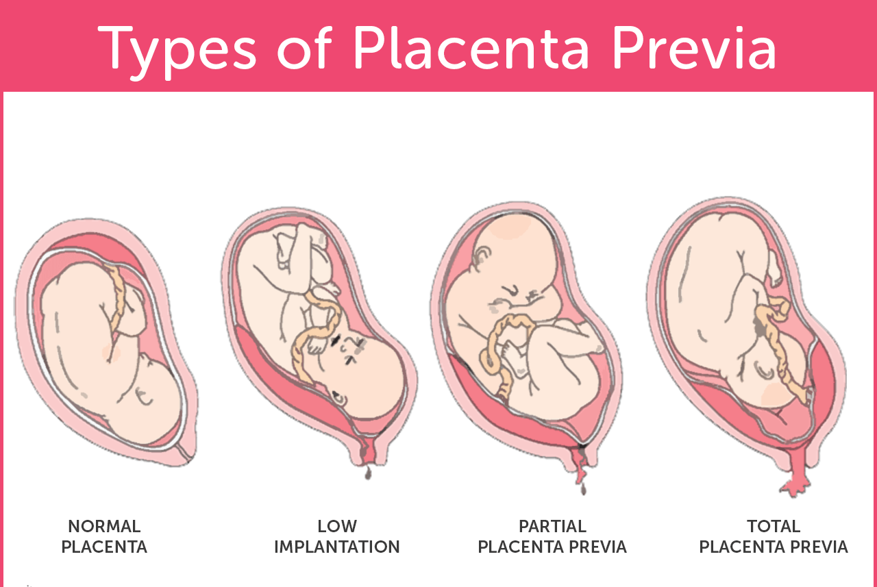 Complications And Risks Of Placenta Previa During Pregnancy 