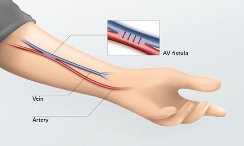 AV-Fistula