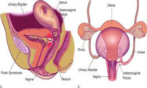 Colovesical-Fistula