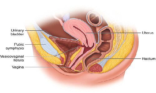 Enterovesical-Fistula