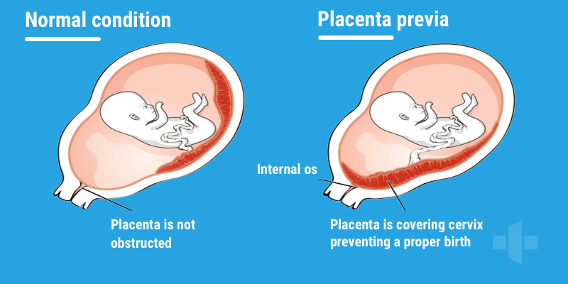 Vasa-Previa-V-Placenta-Previa