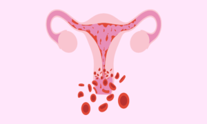 Signs And Symptoms Of Pregnancy After Endometrial Ablation