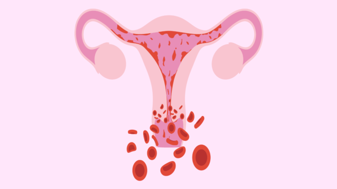 Signs And Symptoms Of Pregnancy After Endometrial Ablation