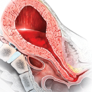 postpartum hemorrhage nursing diagnosis care plan management risk massive