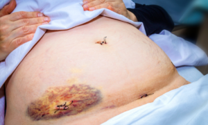 Bruising-After-a-C-Section